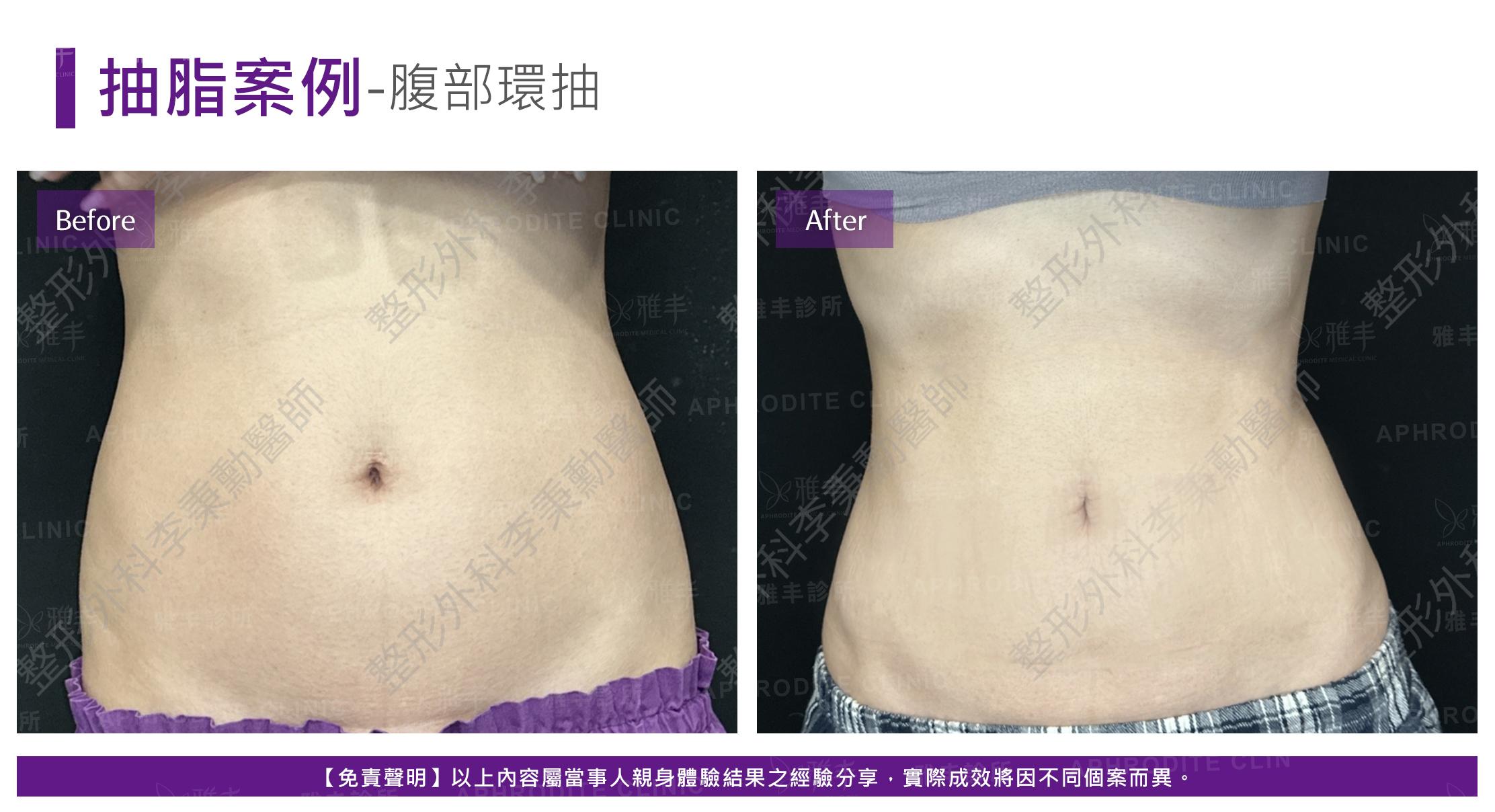 腹部脂雕-case13-F.jpg