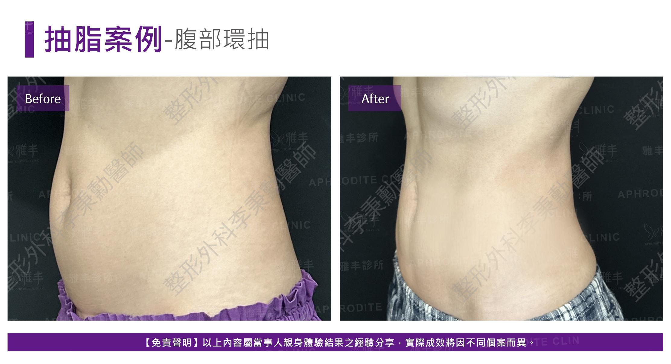 腹部脂雕-case13-L45.jpg