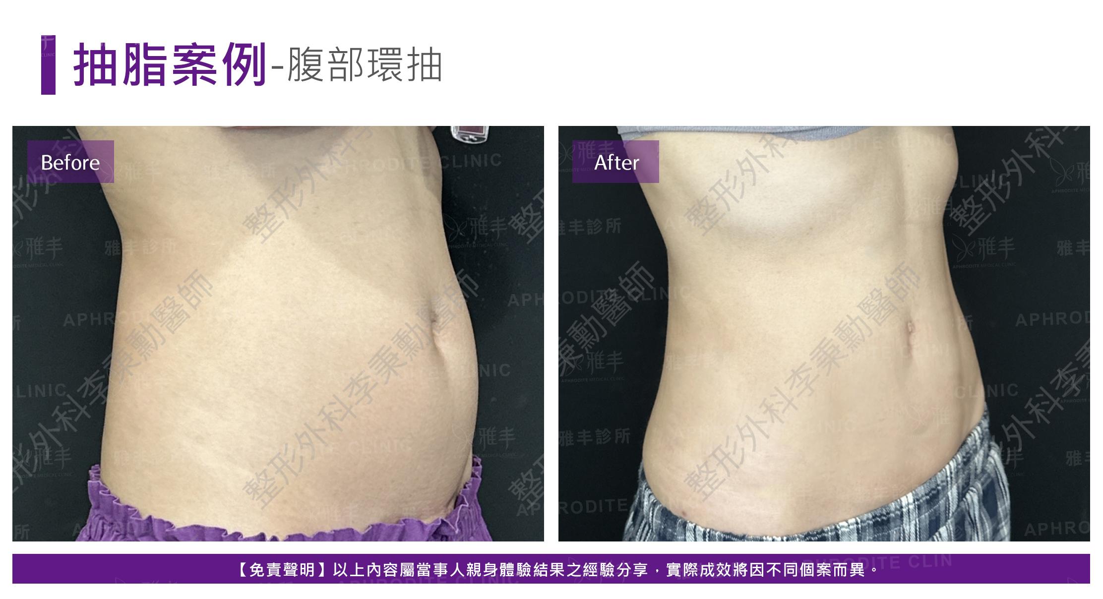 腹部脂雕-case13-R45.jpg