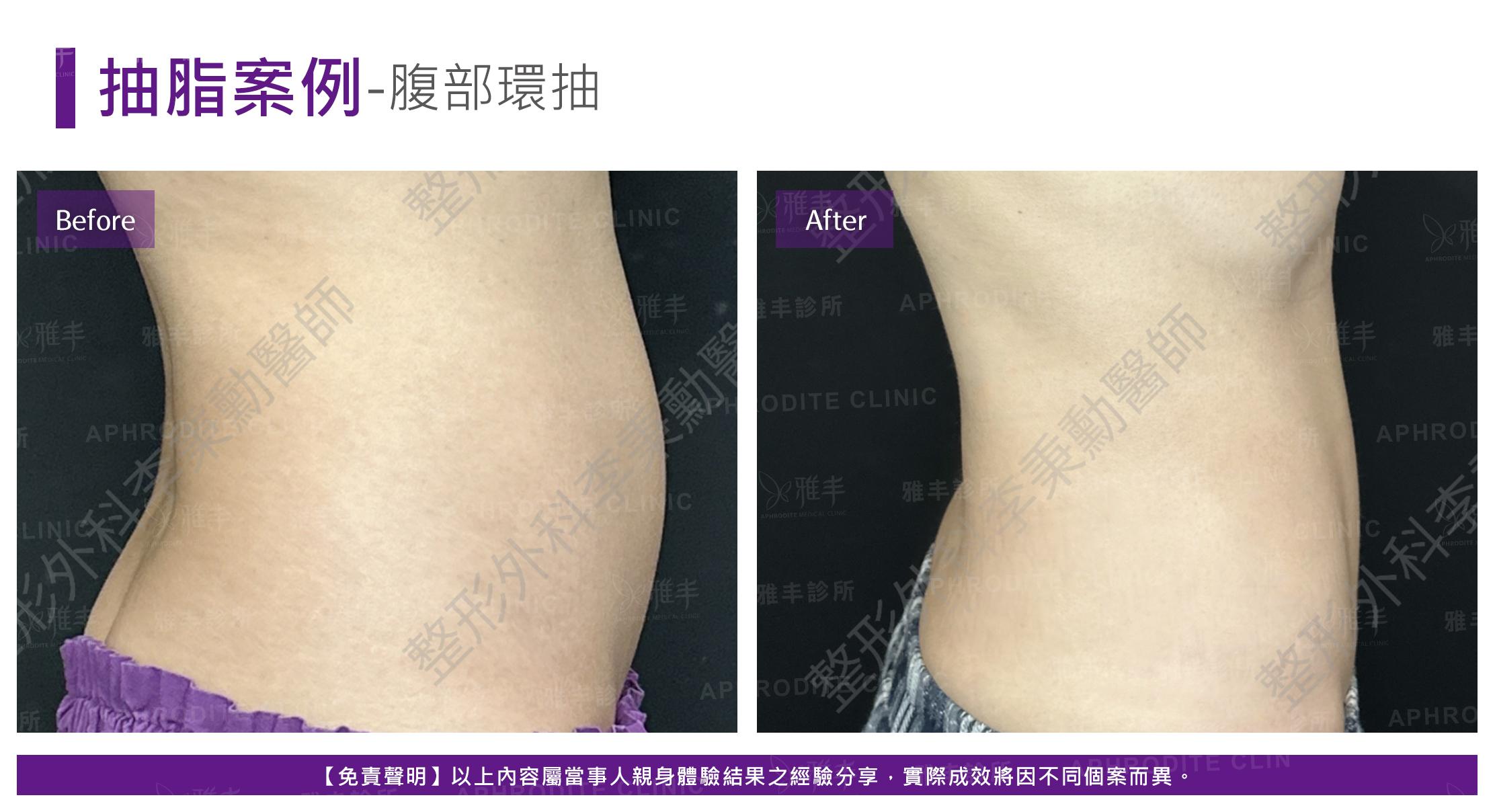 腹部脂雕-case13-R90.jpg