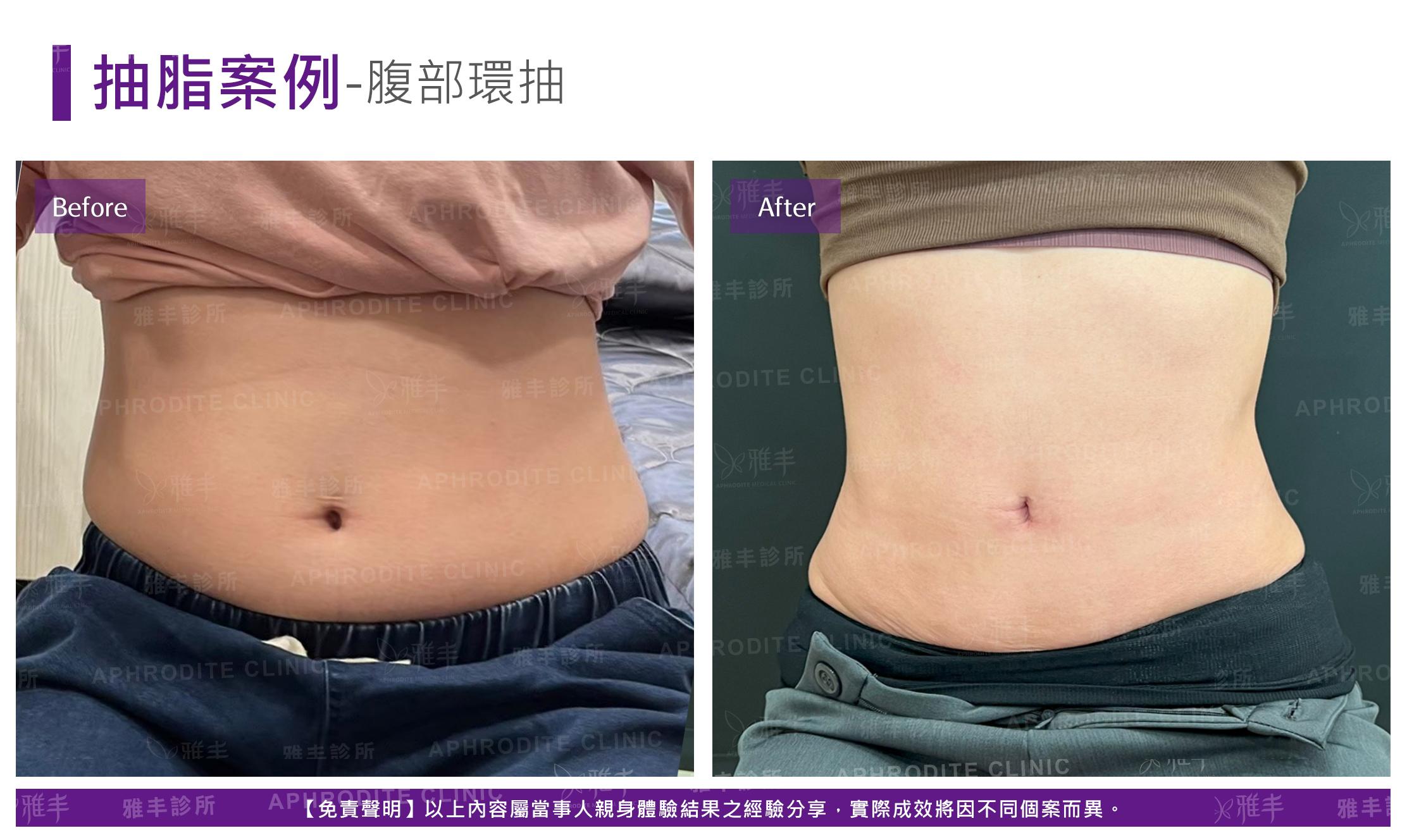 腹部脂雕-case14-F.jpg