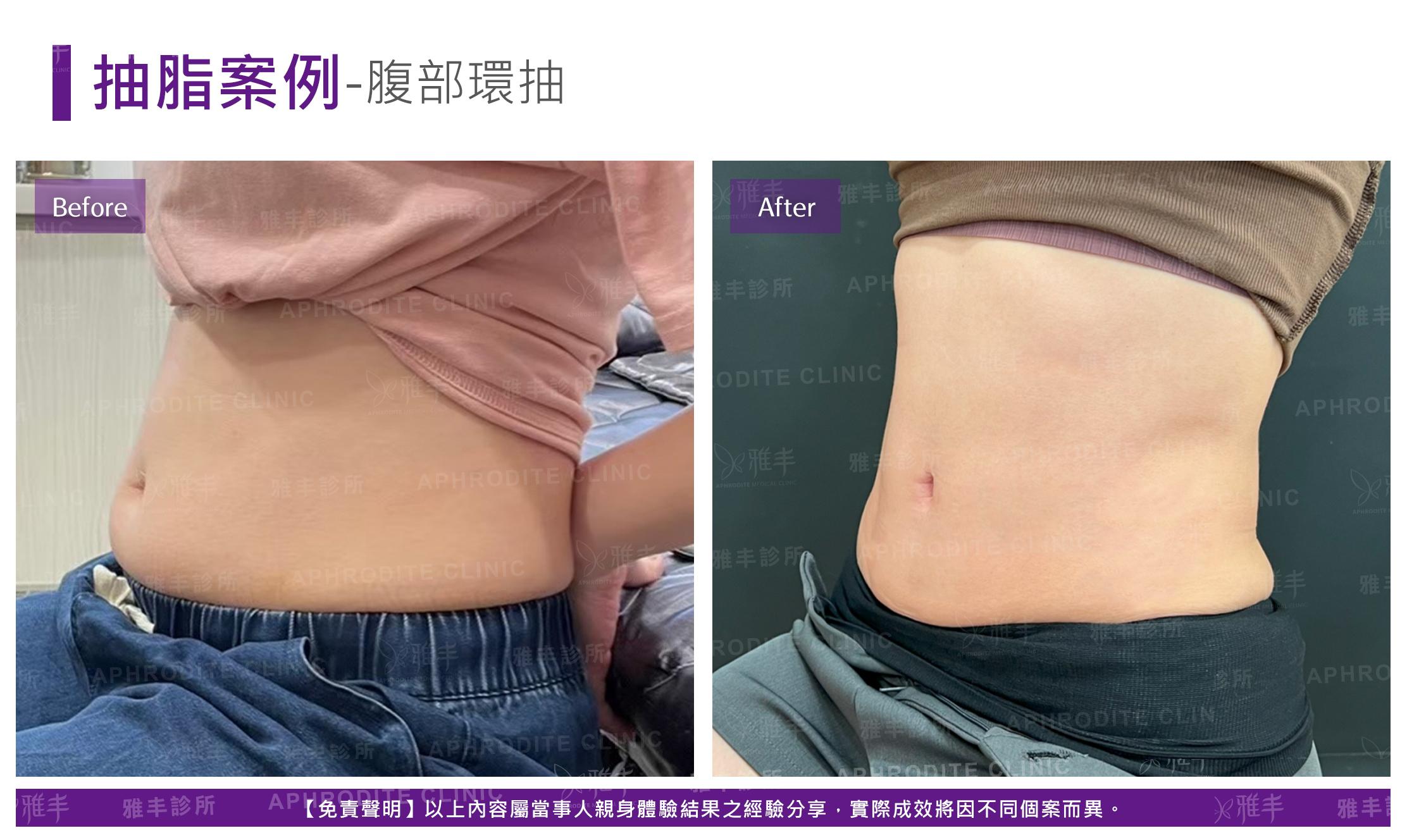 腹部脂雕-case14-L90.jpg