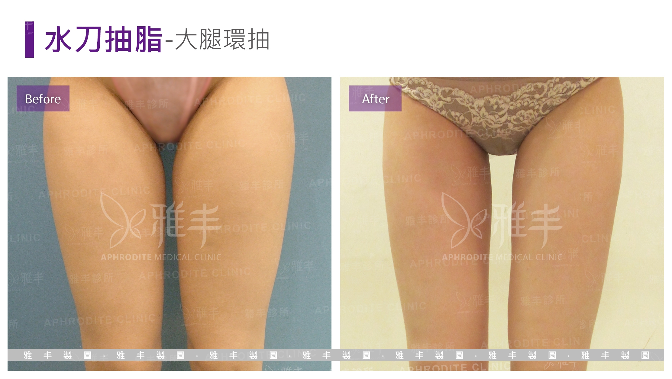 抽脂-大腿環抽(Case4-F)