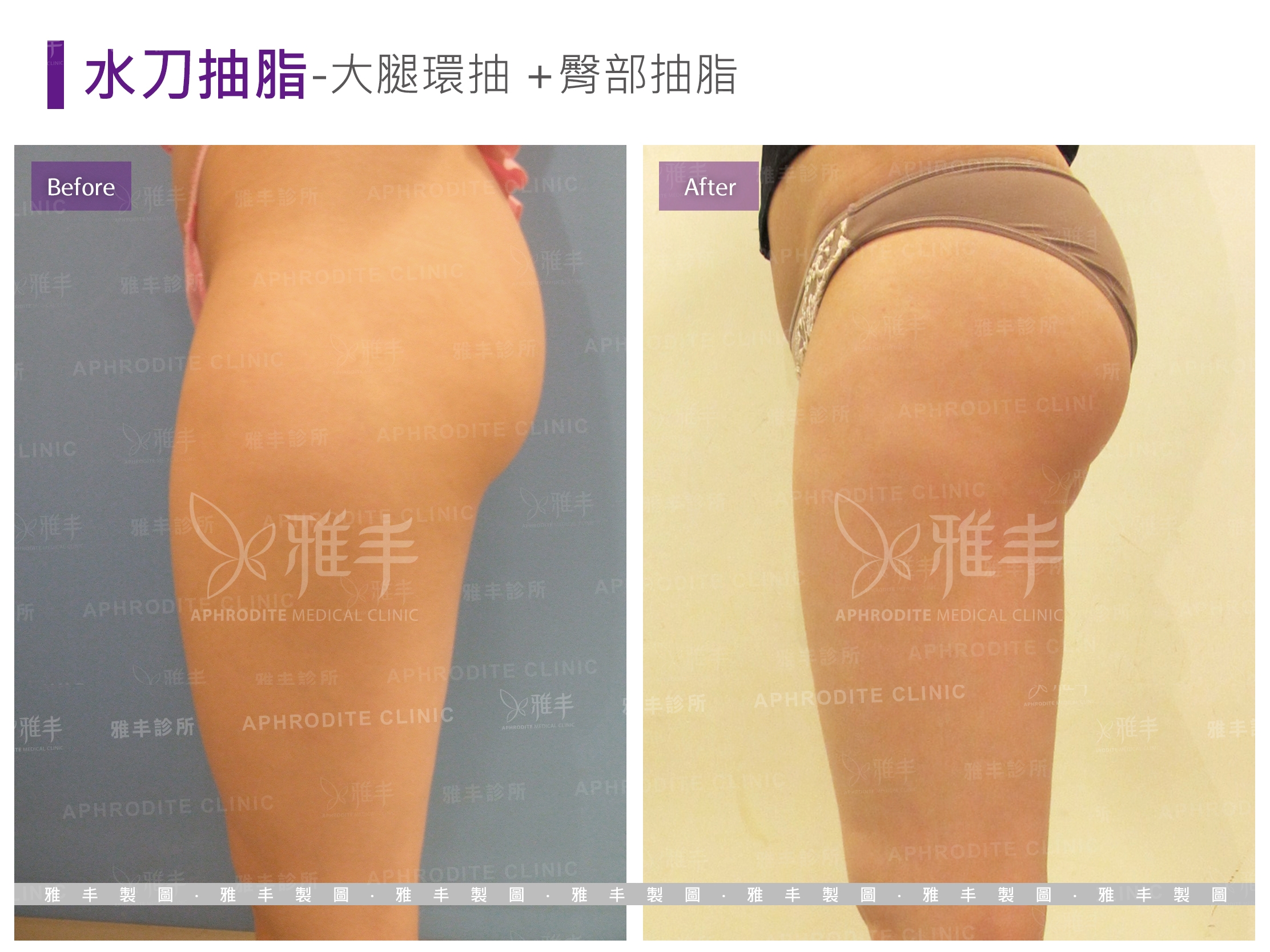 抽脂-大腿環抽+臀部抽脂(Case4-L90)
