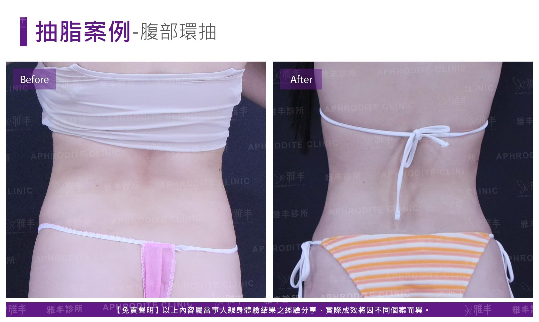腹部環抽-case9_B.jpg