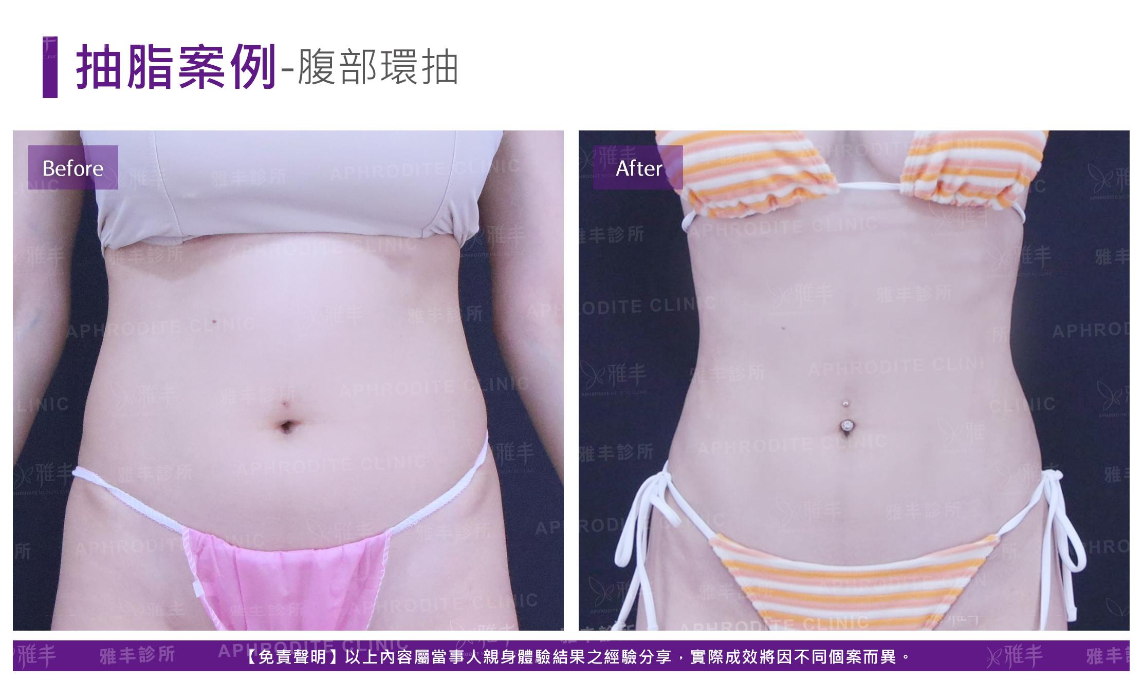 腹部環抽-case9_F.jpg
