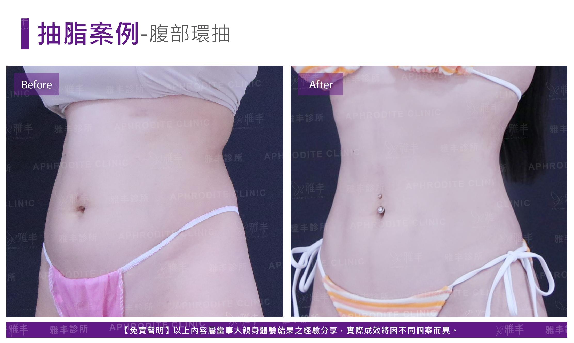 腹部環抽-case9_L45.jpg