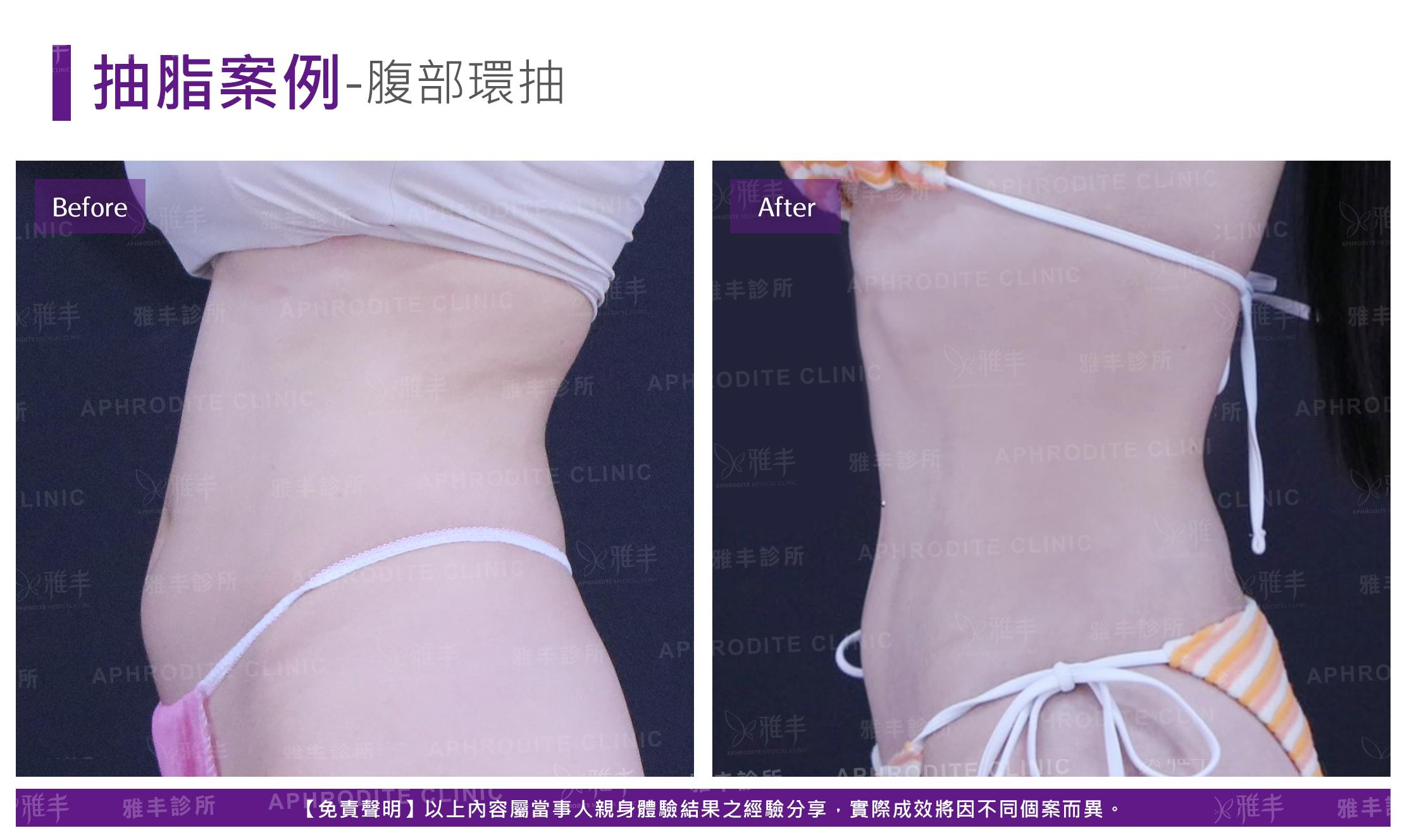 腹部環抽-case9_L90.jpg