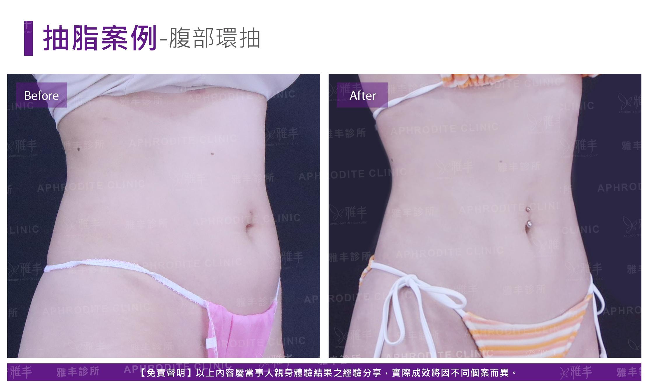 腹部環抽-case9_R45.jpg