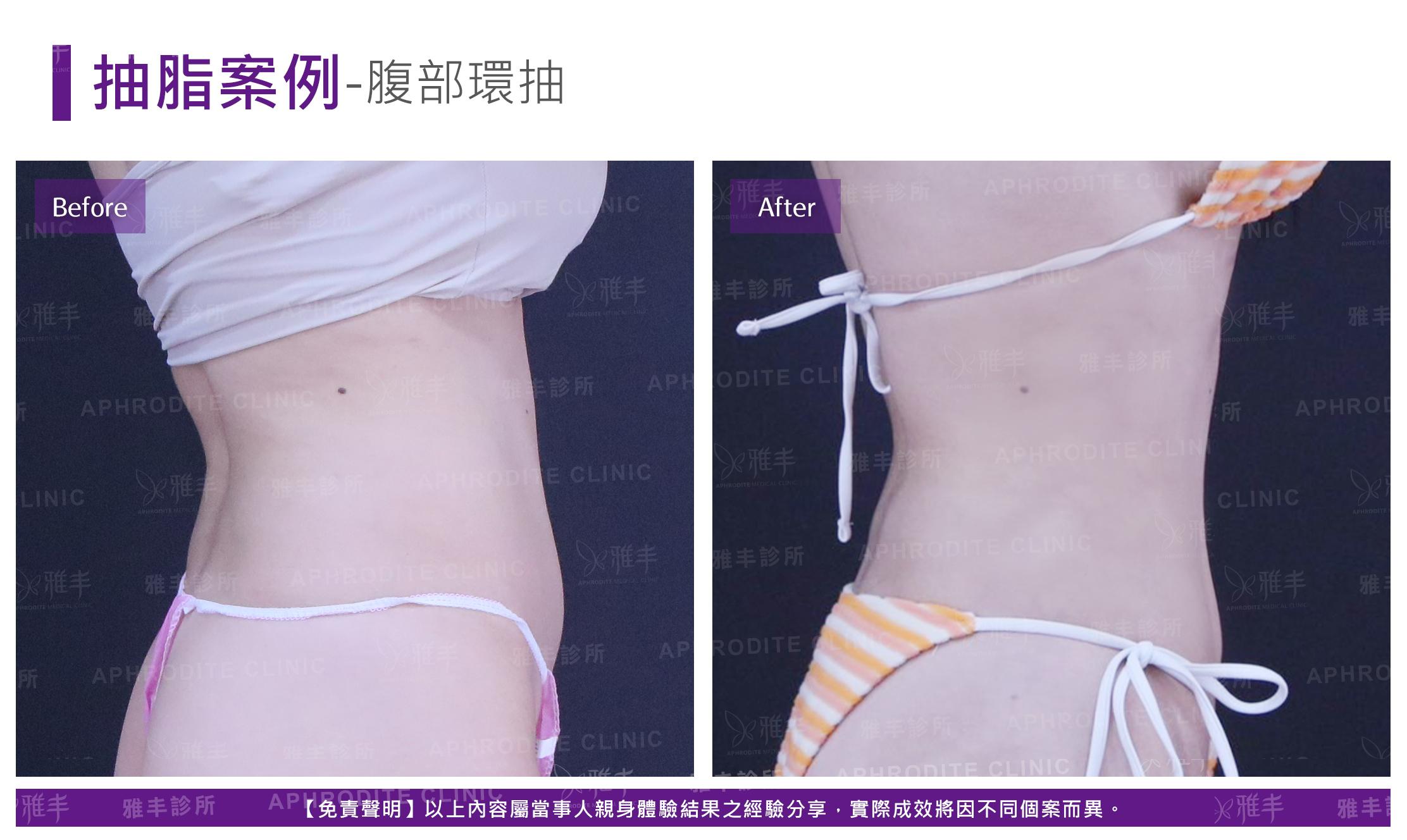 腹部環抽-case9_R90.jpg
