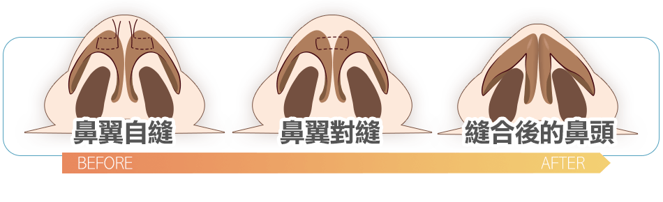 雅丰診所鼻翼鼻孔整形手術