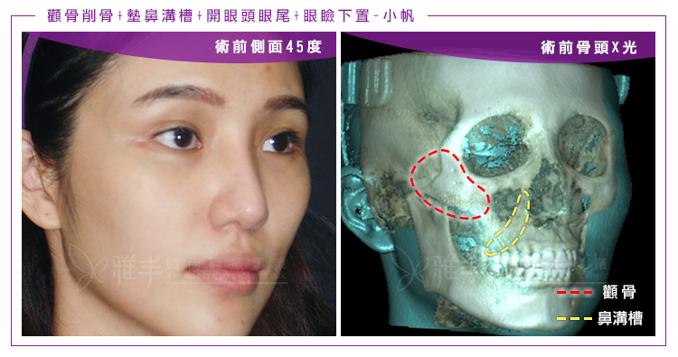 削骨鼻唇溝側面術前CT